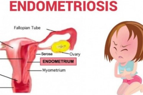 Sono M. e sono affetta da endometriosi